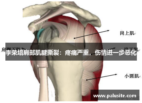 李荣培肩部肌腱撕裂：疼痛严重，伤情进一步恶化